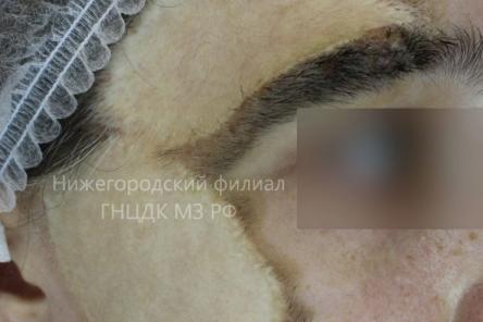 Молодой нижегородке успешно пересадили кожу лица